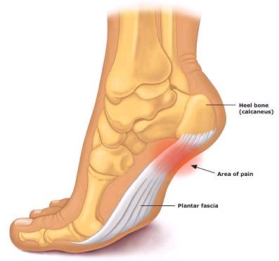 Plantar fasciitis